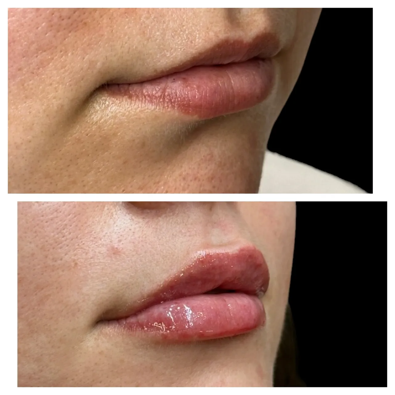 A woman 's lips before and after lip augmentation.