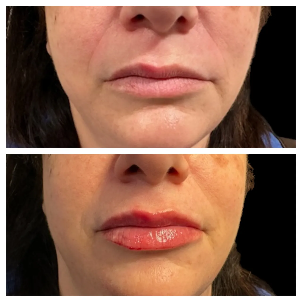 A before and after picture of the lips