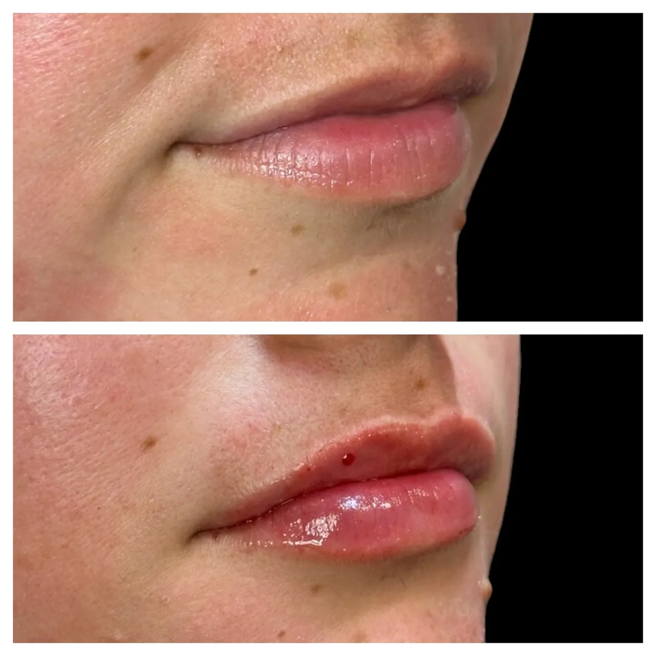 A before and after photo of the lips of a woman.